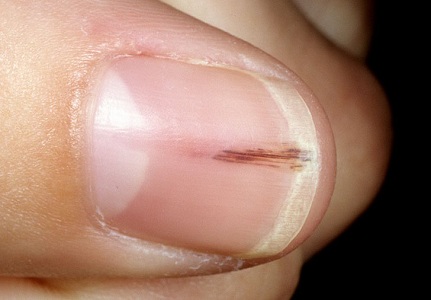 What causes fingernails to separate?